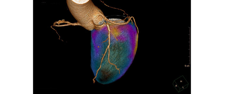 Op de foto is een gecombineerd beeld te zien van water-PET beelden, die de doorbloeding van het hart weergeven, met de CT-hartscan, die de kransslagaderen in beeld brengt. 