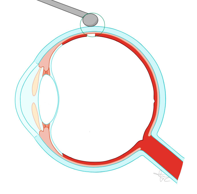 Netvliesloslating, behandeling met cryocoagulatie