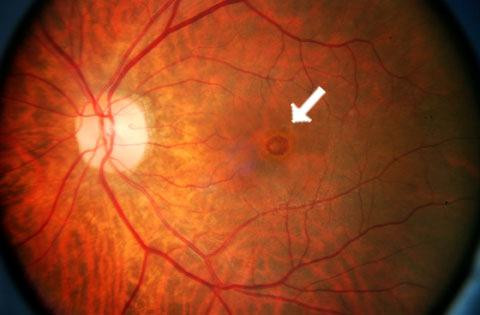 Een foto van de binnenkant van het oog. Vooraanzicht. Links in beeld de oogzenuw van waaruit de bloedvaten van het netvlies ontspringen. In het midden van het beeld de macula met midden in de macula het gaatje (witte pijl).   
