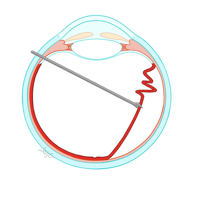 Netvliesloslating, via dezelfde operatieopeningen van de vitrectomie wordt de lens vanaf de achterkant benaderd  