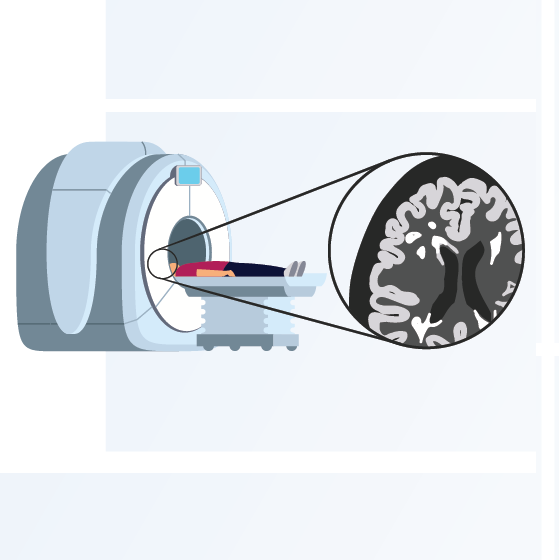 Mogelijk minder MRI-scans nodig bij mensen met stabiele MS op ocrelizumab