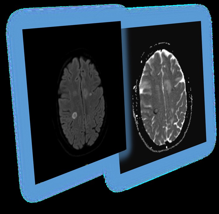 MS-MasterclasS voor neurologen 2026