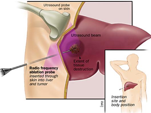 Tijdens radiofrequente ablatie (RFA) wordt een naald in de tumor geplaatst, welke vervolgens wordt verhit. © 2013 Johns Hopkins Colon Cancer Center